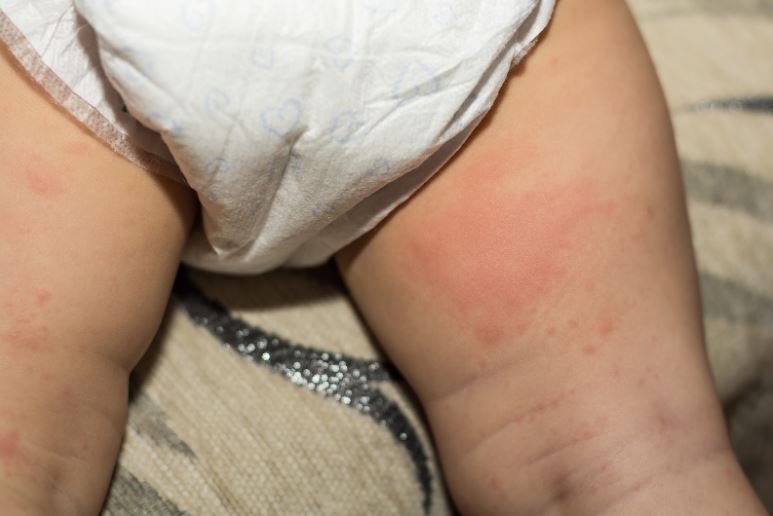 baby dry skin rash