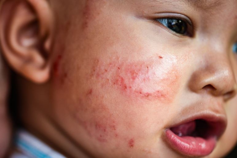 Mamathefox Leading Causes Of Baby Dry Skin Rash And Simple Remedies